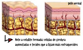 10 armas crontra a celulite